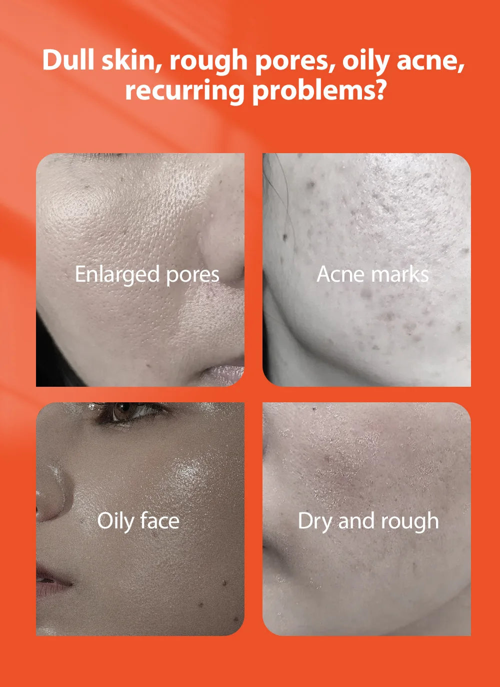 Herbal Acne Removal Face Cream Anti-Acne Gel Treatment Acne Scar Pore Shrinking Eliminate Large Pores Pimples Whitening Face Car