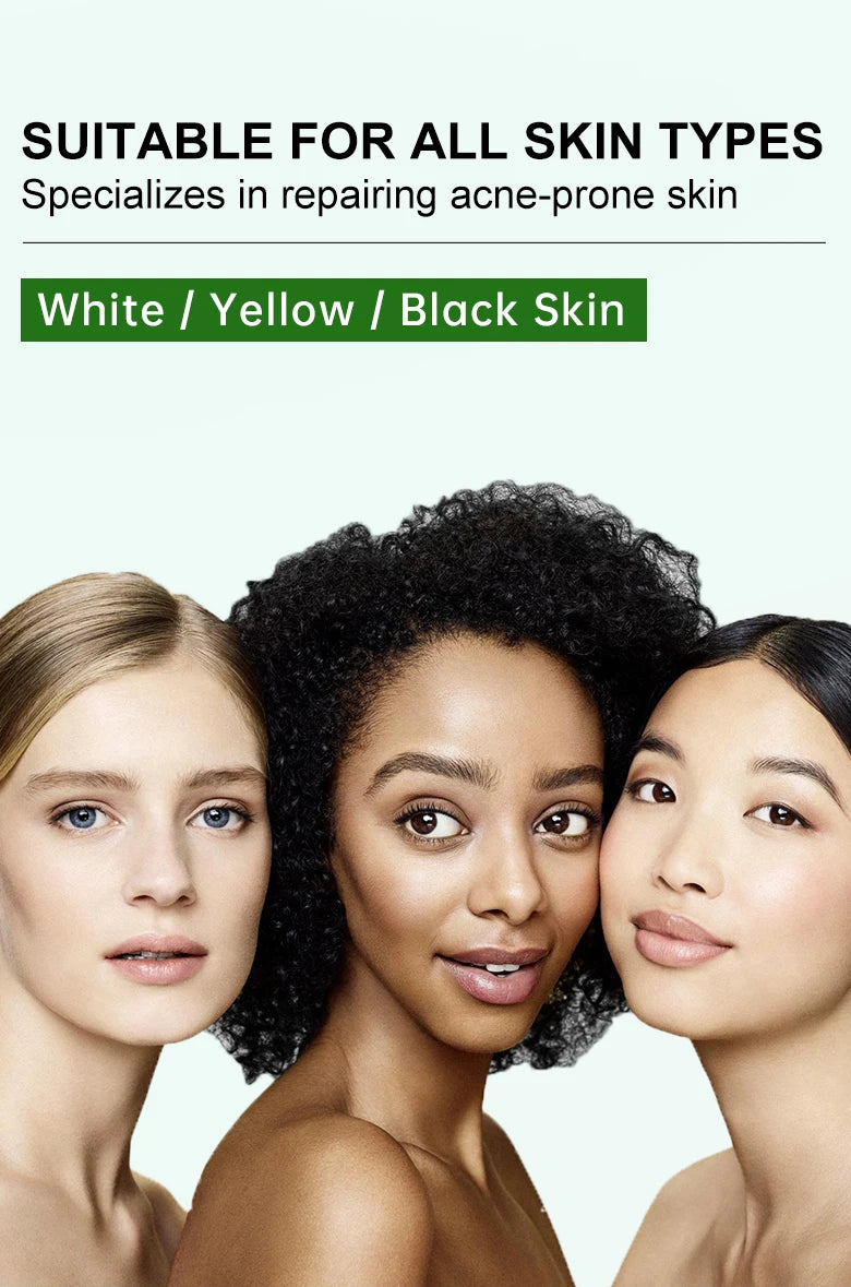 Herbal Acne Face Cream pimple marks removal oil control moisturizing pockmark smooth facial cream skin care products JoyPretty.